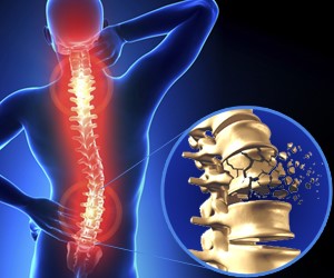 Spinal Cord Injuries (SCI) in the Workplace