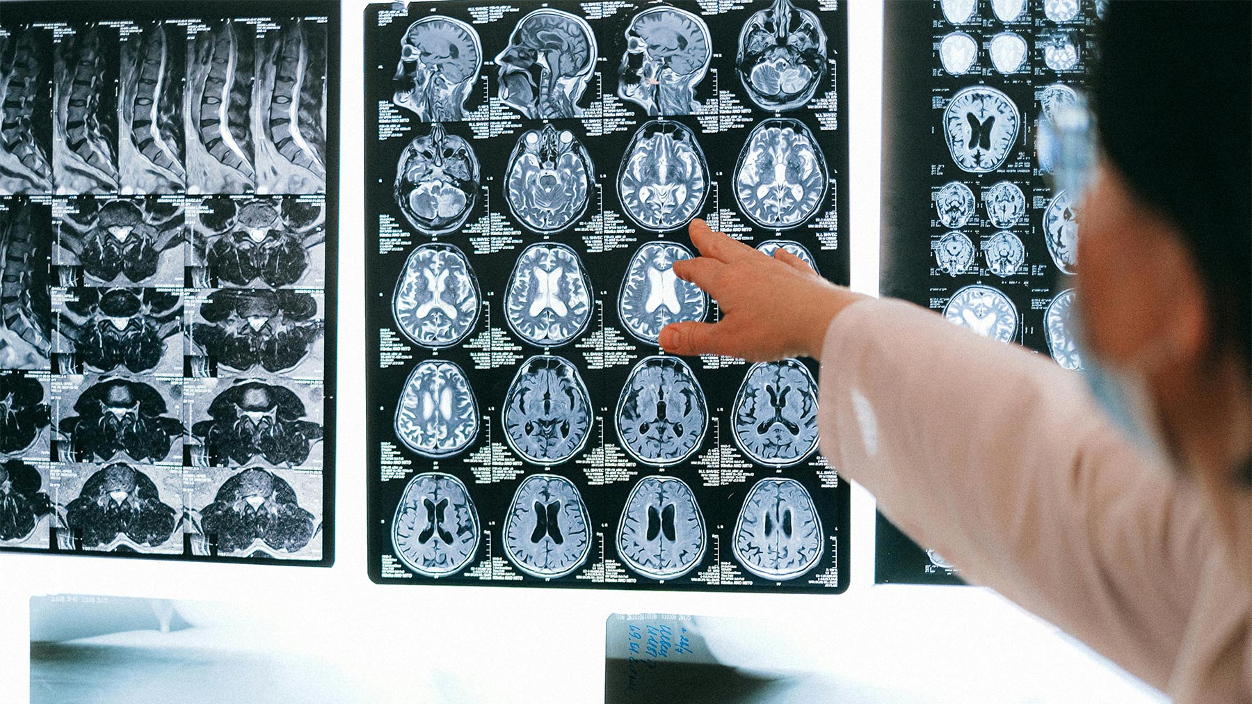 Traumatic Brain Injuries After an Accident: Why Symptoms May Not Appear Right Away